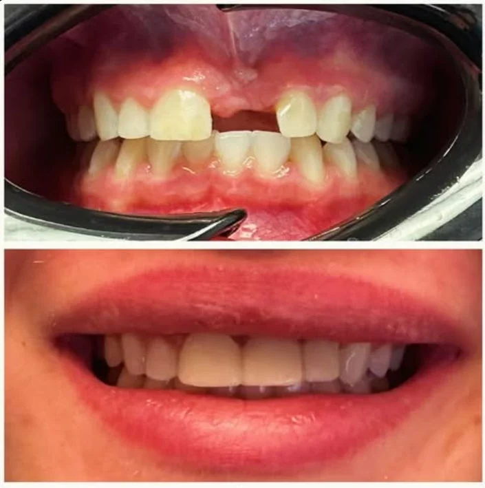 Dental Work Case 7 - Anterior Crown & Bridge Transformation